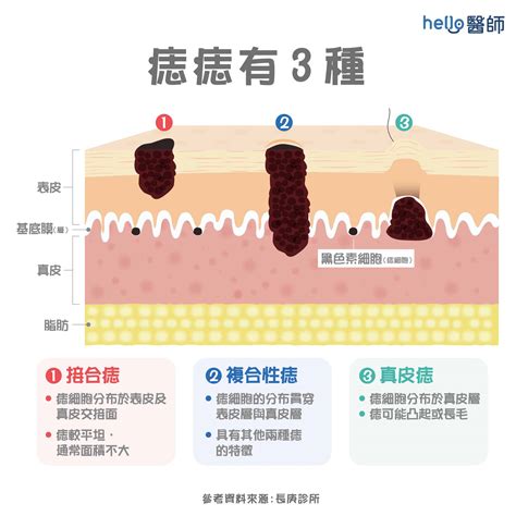 陰莖痣|陰莖上的痣是否需要處理？可能是皮膚病變嗎？